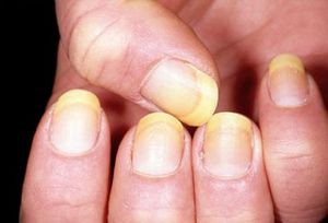 Як боротися із захворюваннями нігтів, а також як їх запобігти